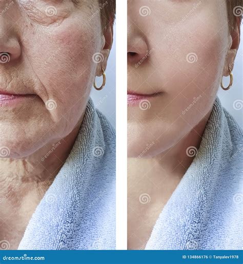 Woman Wrinkles Removal Dermatology Medicine Correction Face Before And