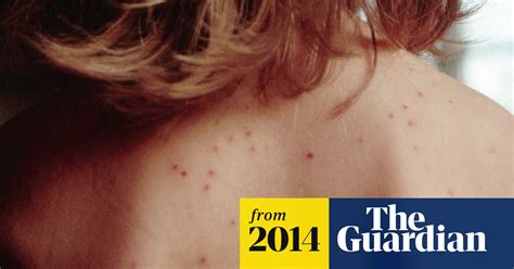 Measles Health Alert Hits Sydney Australia News The Guardian
