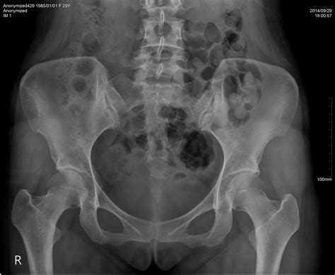 Normal Pelvic X Ray Women Telegraph