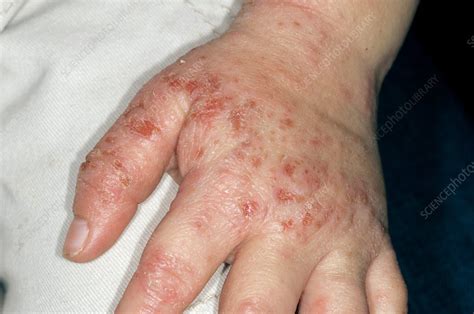 Infected Atopic Eczema On The Hand Stock Image C0117361 Science