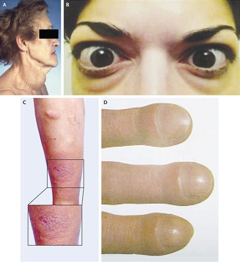 It is a form of idiopathic lymphocytic orbital inflammation, and although its pathogenesis is not completely understood, autoimmune activation of orbital fibroblasts, which in tao express the tsh receptor, is thought to play a central role. Graves' Disease | NEJM