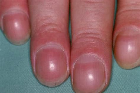 Krankheiten Erkennen Was Fingern Gel Ber Ihre Gesundheit Verraten