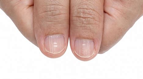 In most cases, vertical lines are normal fingernail ridges and are not a sign of any medical health problem. Fingernail Ridges Can Indicate a Thyroid Problem ...