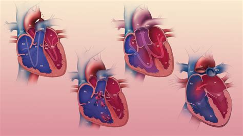 Understanding Cyanotic Congenital Heart Disease World Of Medic