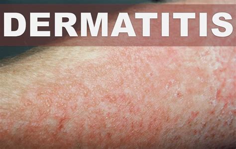 Eczema Dermatitis La Escuelita Médica