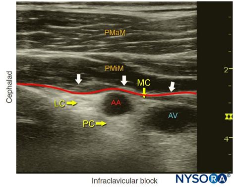 Ultrasound Guided Infraclavicular Brachial Plexus Block Nysora