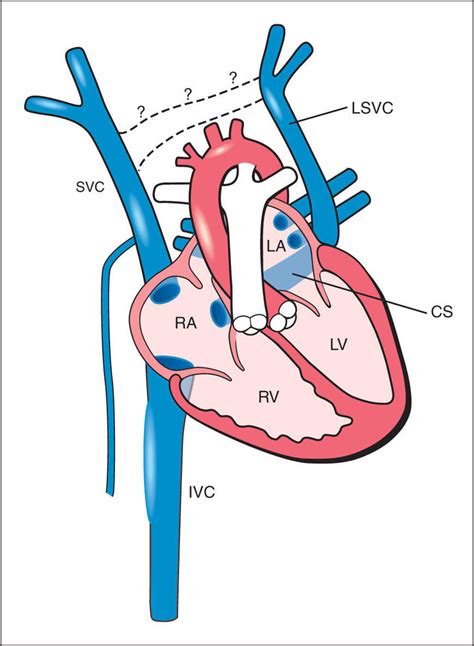 The venous drainage system of the heart is shown diagrammatically in fig. What Does The Coronary Sinus Drain Into - Best Drain ...