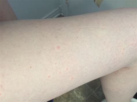 Itchy Red Bumps On Legs Glow Community