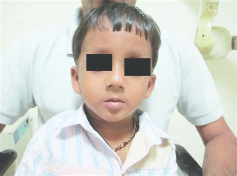 Clinical Photograph Showing Typical Dysmorphic Facies Elongated Face