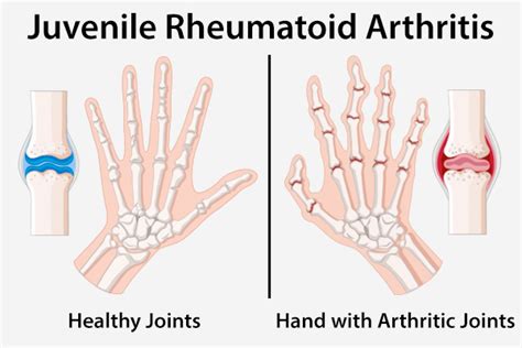 Juvenile Rheumatoid Arthritis Types Symptoms And Treatment 2022
