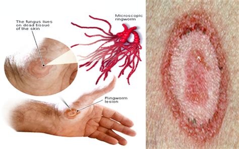 Dermatophytes That Causes Cutaneous Mycoses In Humans And How To Deal