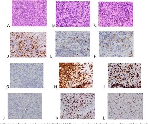 Figure 2 From Case Report Of Primary Cd20 Negative Diffuse Large B Cell