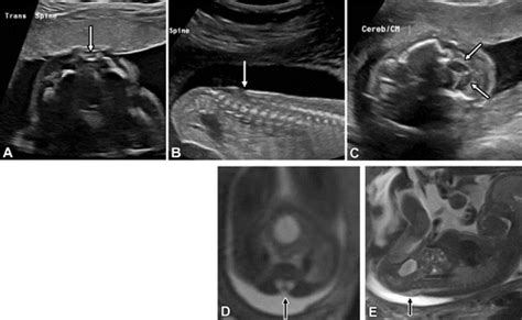 Multimodality Imaging Evaluation Of Fetal Spine Anomalies With