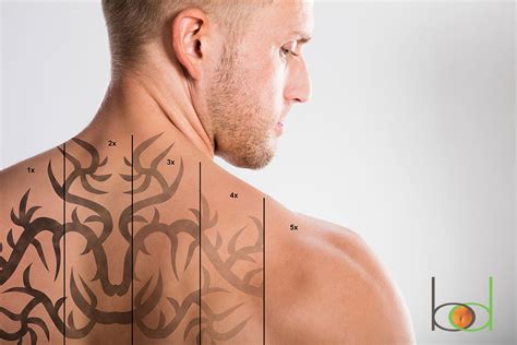 How Growing Technology Is Improving Tattoo Removal