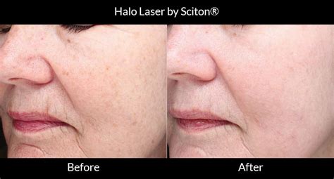 Halo Laser By Sciton® Remington Aesthetics And Cosmetic Surgery