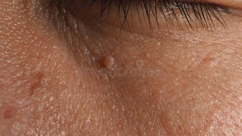 Wart On Face Macro Shot Of Wart Near Eye Stock Photo Image Of