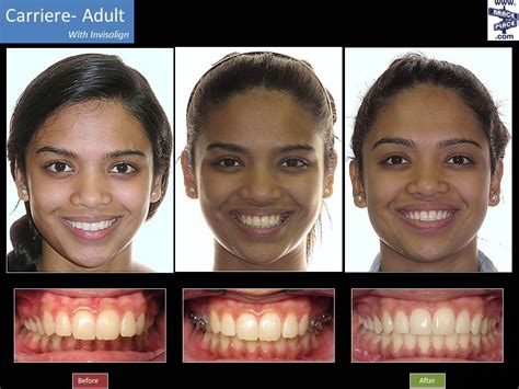 Invisalign Vs Braces Before And After My Xxx Hot Girl