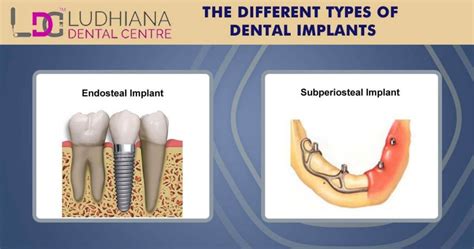 Thinking Of Dental Implants Know Your Type
