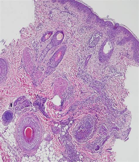 Eosinophilic Pustular Folliculitis In Infancy Report Of A New Case