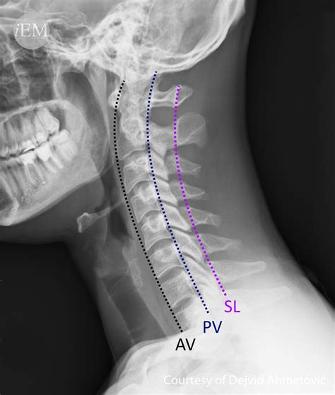 Spine Lateral View