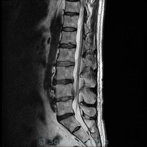 Cervical Disc Herniation MRI