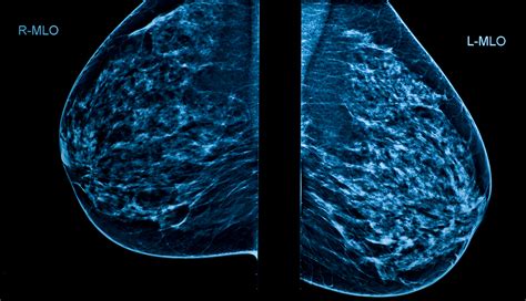 Mammograms When And How Often Should Women Get Them