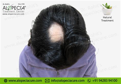 Alopecia Areata Treatment Types Causes