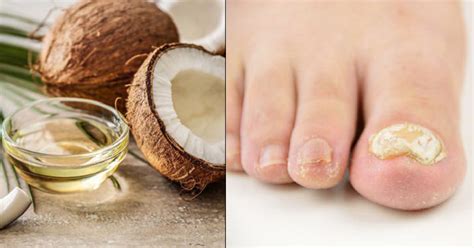 Coconut oil for treating toenail fungus. Coconut Oil for Toenail Fungus | Toenail Fungus Home ...