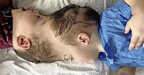 Conjoined Twins With Fused Brains Successfully Separated One Of The