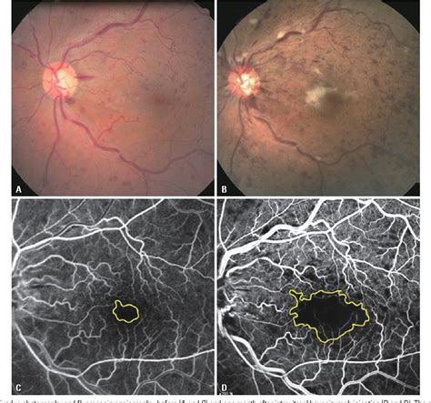 Figure 1 From Angiographically Documented Macular Ischemia After Single