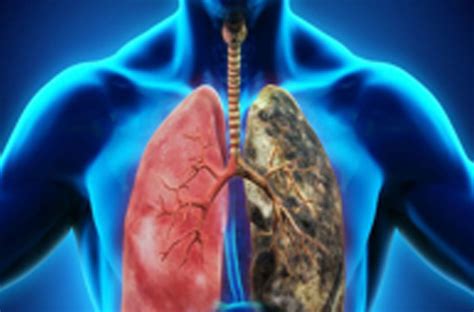 Lower Respiratory Tract Disease Lung Disease