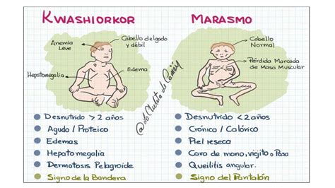 Diferencias Entre Marasmo Y Kwashiorkor La Chuleta De CarriÓn Udocz