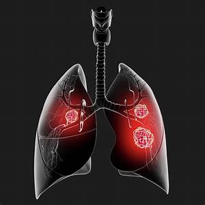 Lung Cancer Photograph by Pixologicstudio/science Photo Library - Fine Art America Lung Cancer  