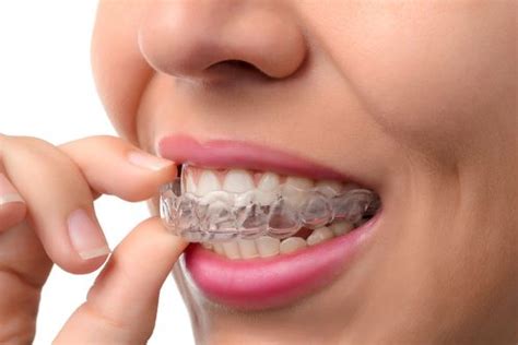 Maybe you would like to learn more about one of these? Removable vs Permanent Retainers - Spillers Orthodontics