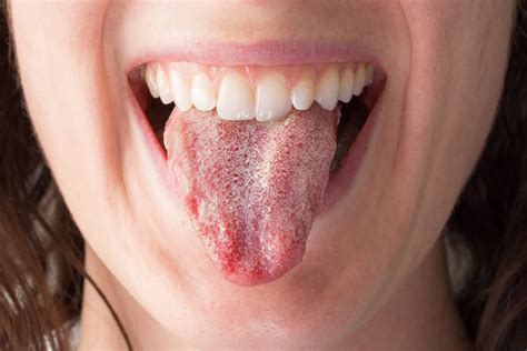 Causas De La Candidiasis Oral Una Infección Común De La Boca Colgate®