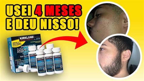 Minoxidil Antes E Depois EveluÇÃo Completa Youtube