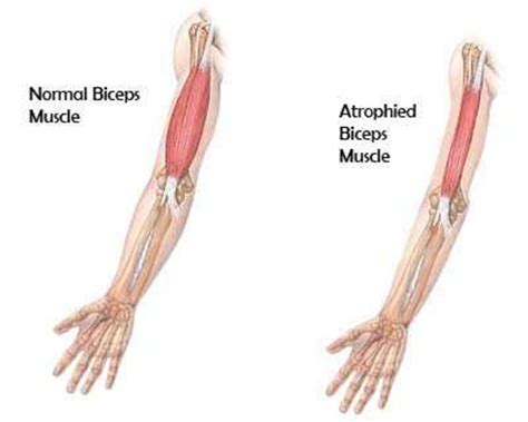 Are You Suffering From Muscle Atrophy Hubpages