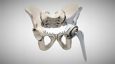 3d Printing Of Implantable Medical Devices Mtaa