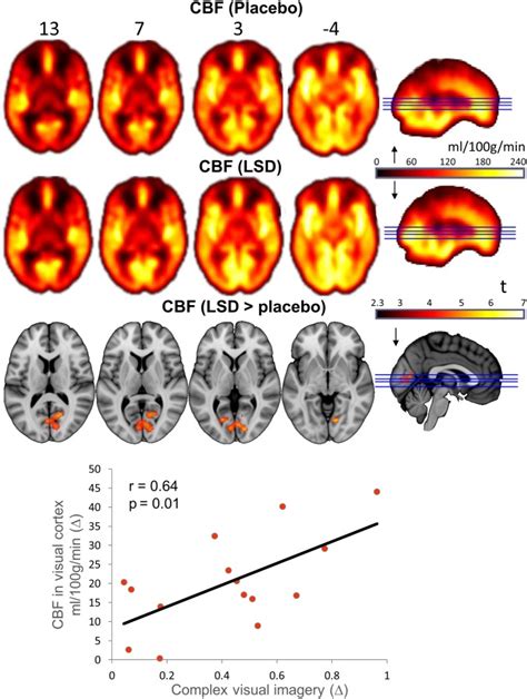 Neural Correlates Of The Lsd Experience Revealed By Multimodal Neuroimaging Abstract Europe Pmc
