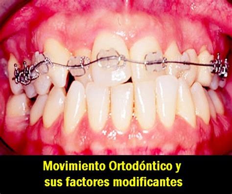 Ortodoncia Movimiento Ortodóntico Y Sus Factores Modificantes