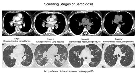 Snippet 15 Ct Scan Findings In Sarcoidosis