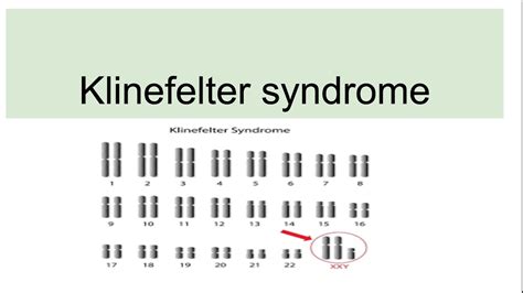 Klinefelter Syndrome Genetics Characteristics Diagnosis YouTube