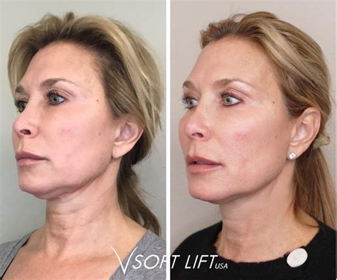 Would You Choose A Neck Lift Over A Facial Cosmetic Procedure