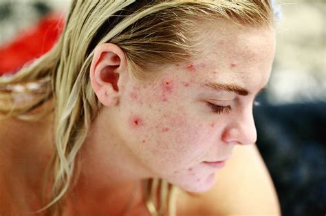 You Will Not Believe These Celebs Suffer From Acne Daily Gossip