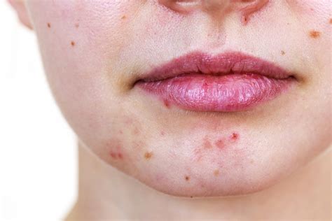 What Causes Acne The 3 Major Reasons Why Acne Occurs