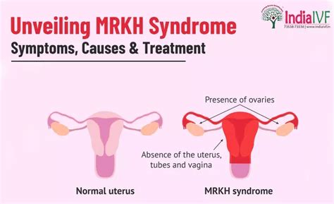 Unveiling Mrkh Syndrome Symptoms Causes And Treatment At India Ivf