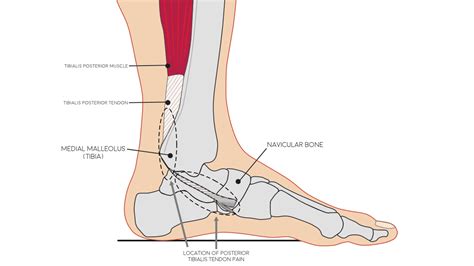Posterior Tibial Tendonitis Foot Pain Explored Vlr Eng Br