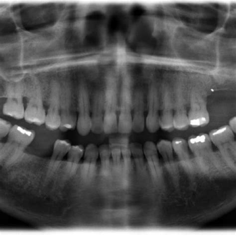 A Panoramic Radiograph Reveals Carotid Artery Calcification Of A