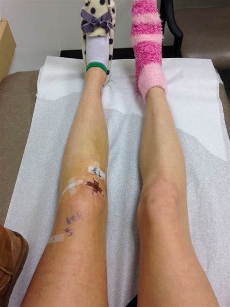 Acl Post Surgery Day 4 Day 5 Surgeon Follow Up Nina Elise