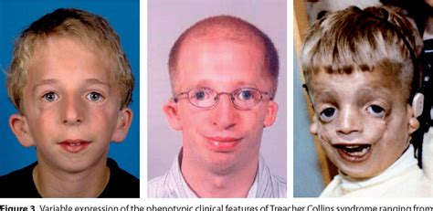 Dysostosis mandibulofacialis) ist eine erbliche erkrankung, die zu gesichtsfehlbildungen (craniofaziale dysmorphie) führt. Figure 3 from Clinical Implications of Treacher Collins ...